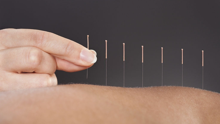 Nous vous proposons des rendez-vous d’Acupuncture